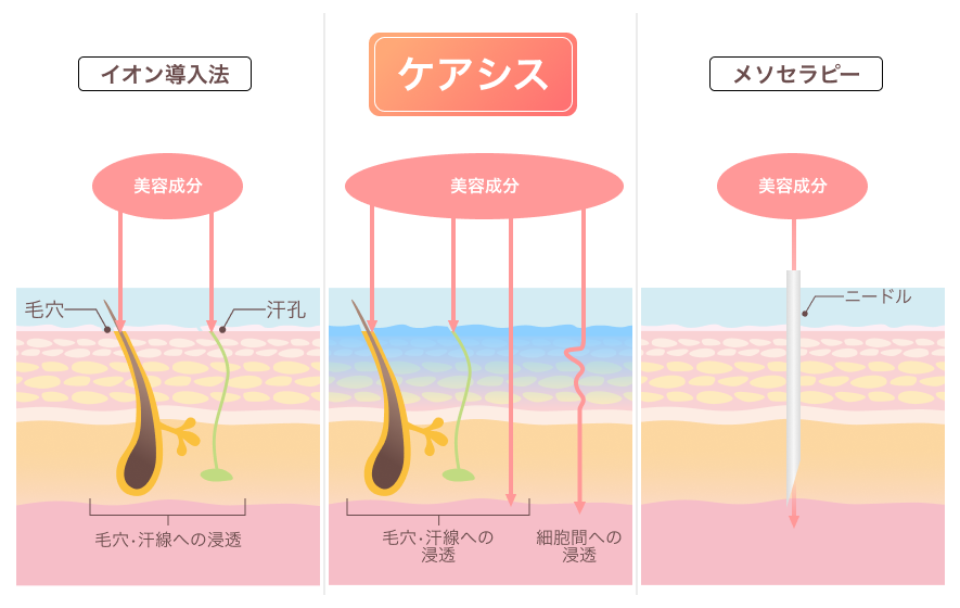 ケアシス‐Sによるエレクトロポレーション