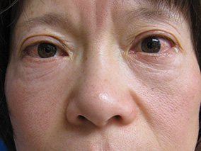 眼瞼挙筋前転法術後の症例写真