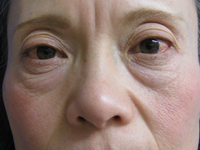 眼瞼挙筋前転法術前の症例写真