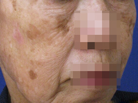 美肌治療機器 ライムライト術前の症例写真