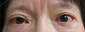 眼瞼下垂手術の症例写真（After）