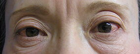 眼瞼下垂手術の症例写真（Before）