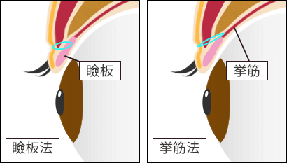 二重整形 埋没法の瞼板法と挙筋法の横から見た図解
