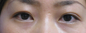 二重整形埋没法ハートライフ二重術3点留め術後の症例写真