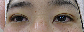二重整形埋没法ミュラー筋タッキング法術後の症例写真