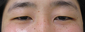 二重整形埋没法ミュラー筋タッキング法術前の症例写真