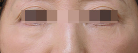 目の下のクマ・たるみとり術後の症例写真