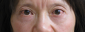 目の下のクマ・たるみとり術後の症例写真