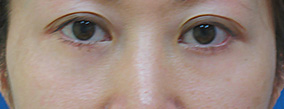 目の下のクマ・たるみとり術後の症例写真