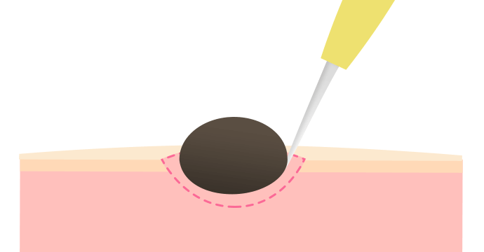 傷跡をほとんど残さないホクロ除去 静岡浜松ハートライフクリニック