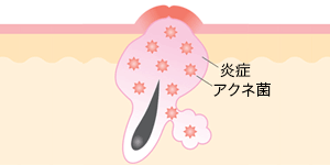 赤ニキビ