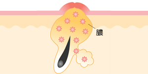 黄ニキビ