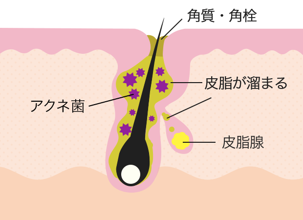 毛穴に皮脂が溜まるとアクネ菌が繁殖する