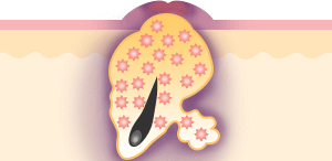 紫ニキビ