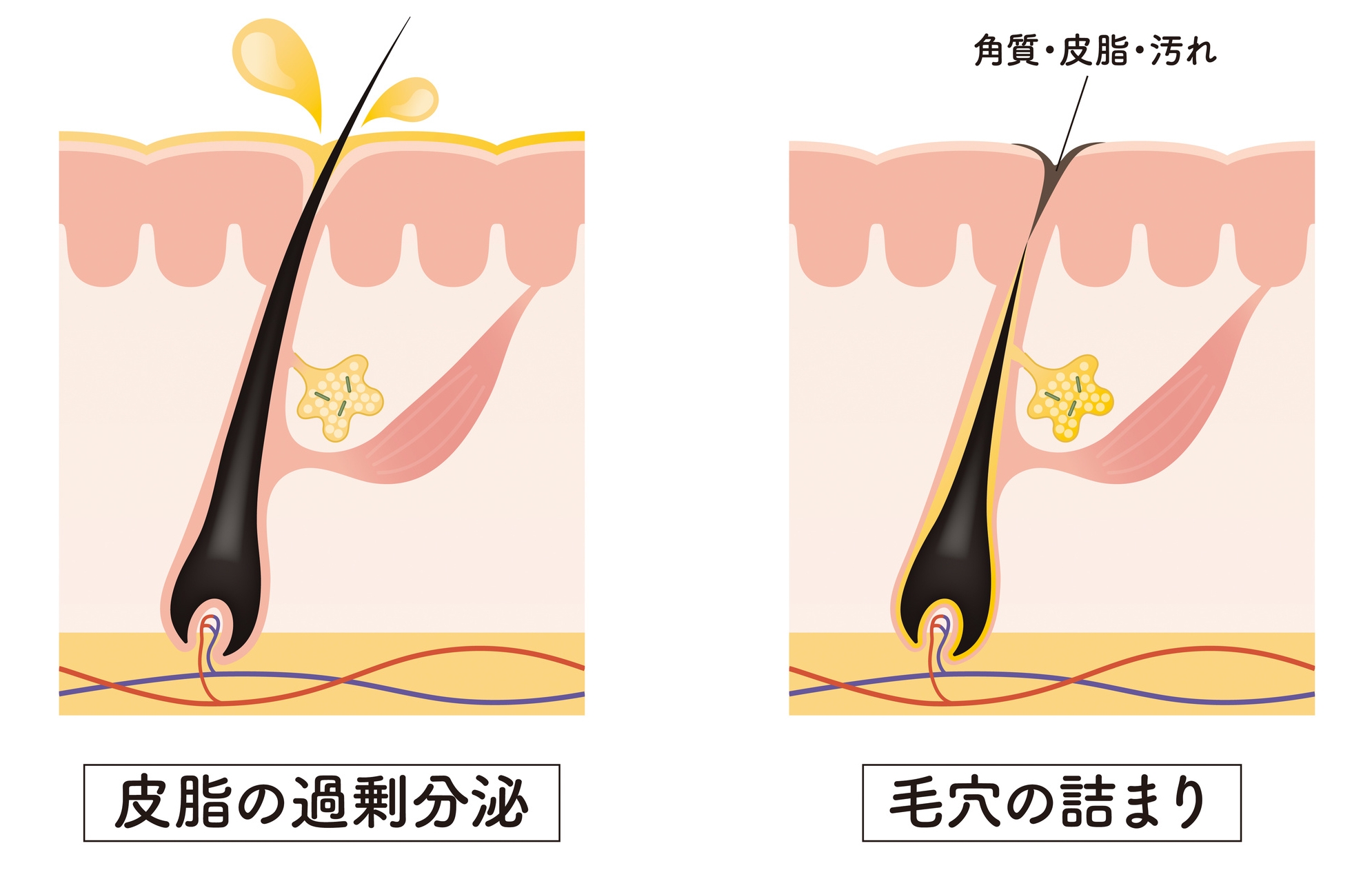 ニキビのできはじめ