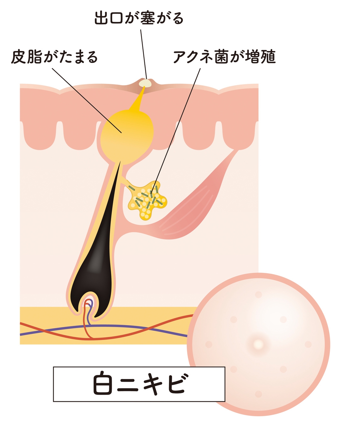 白ニキビの状態