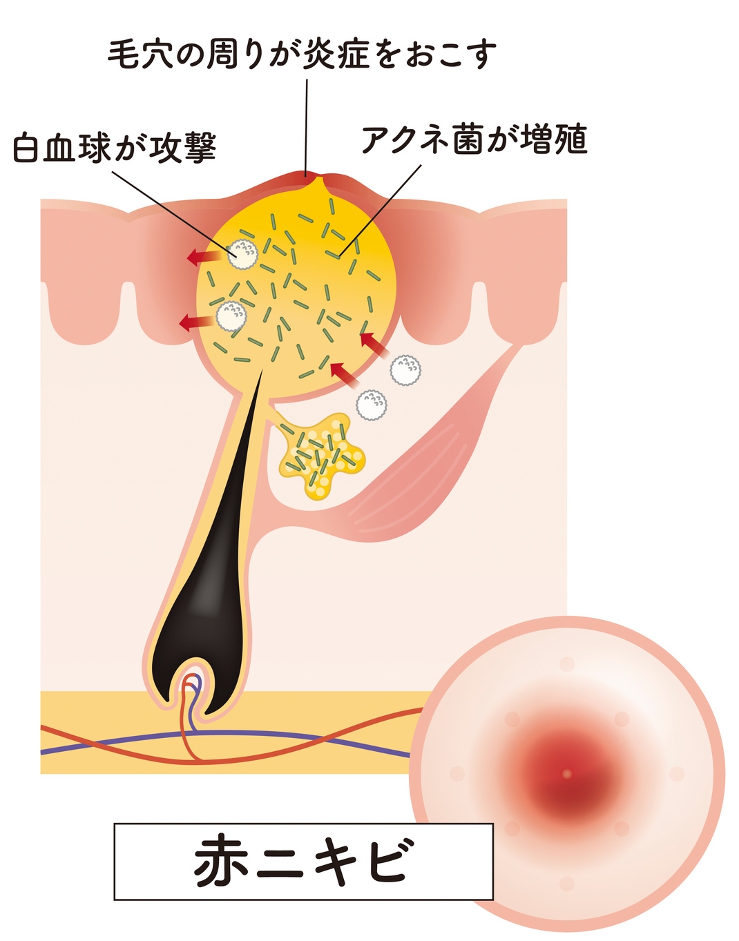 赤ニキビの状態