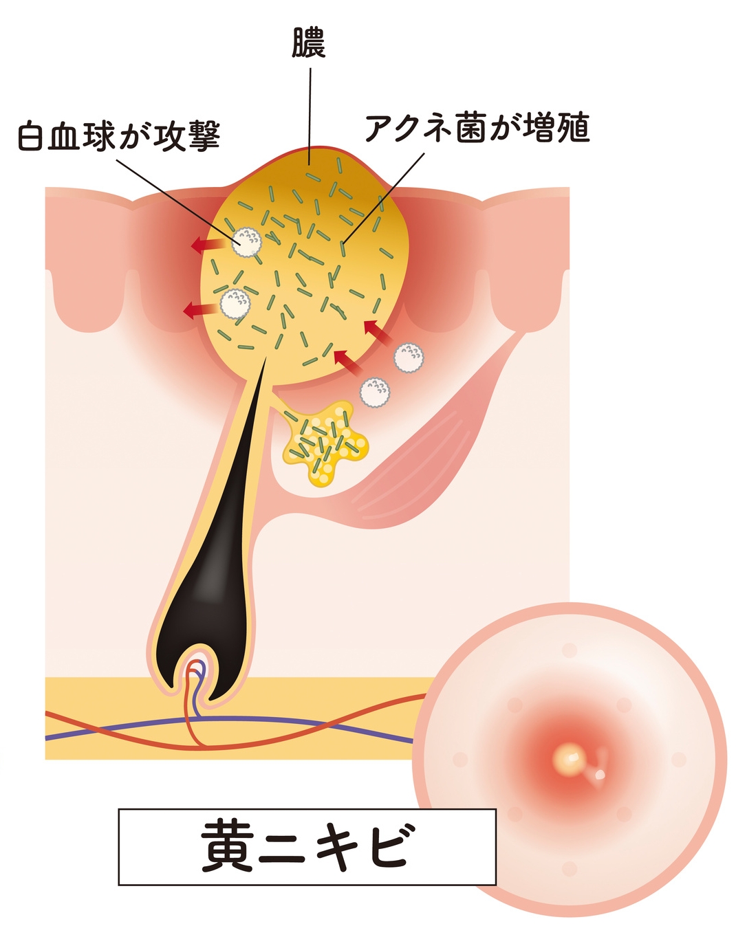 黄ニキビの状態