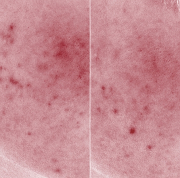 ニキビ軽症の方のVISIA画像