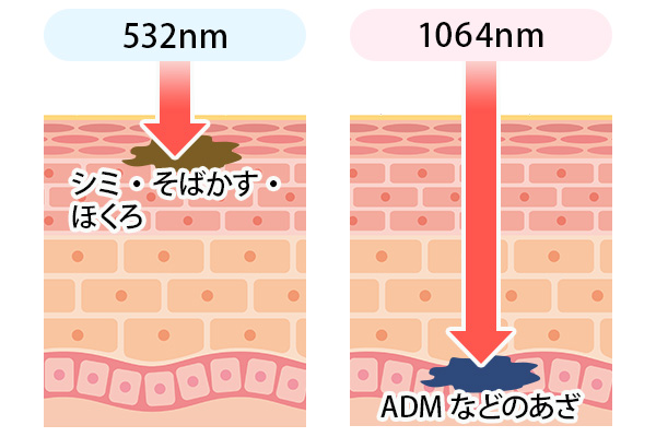 シミ取りレーザーの2種類の波長の図解