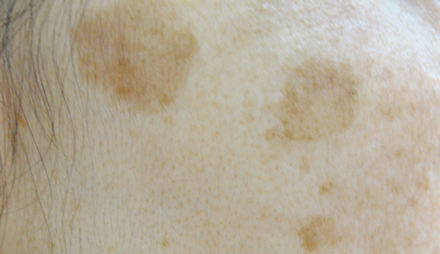 老人性色素斑の症例写真