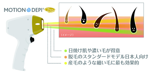 ソプラノアイスプラチナムによる3波長のレーザー照射