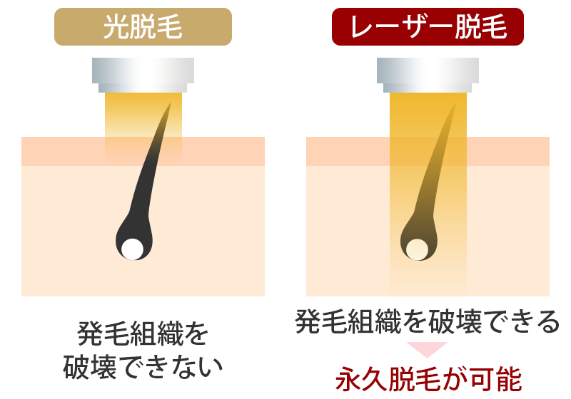 レーザー脱毛と光脱毛の違い