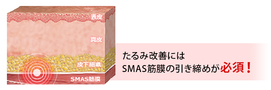 ウルトラセルQプラスはSMAS筋膜に十分な熱エネルギーを与える