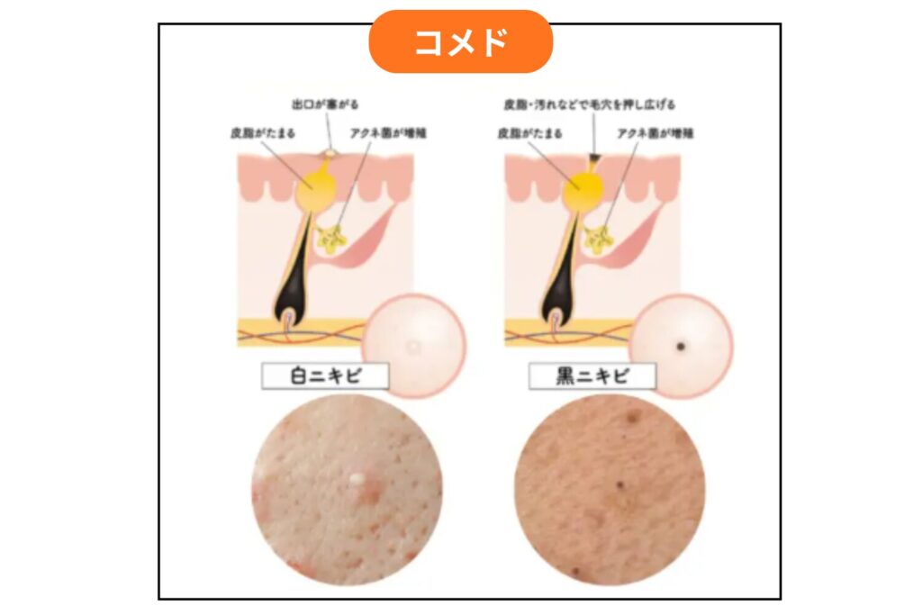 白ニキビ・黒ニキビはコメドの一種
