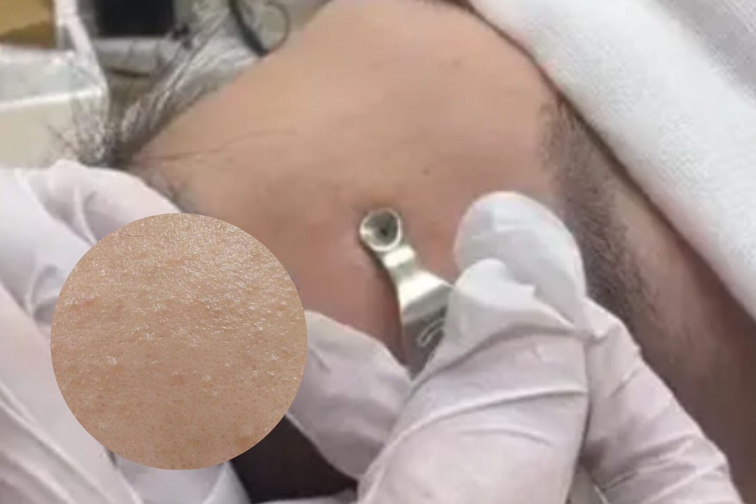 コメドの治し方|原因と予防の基本