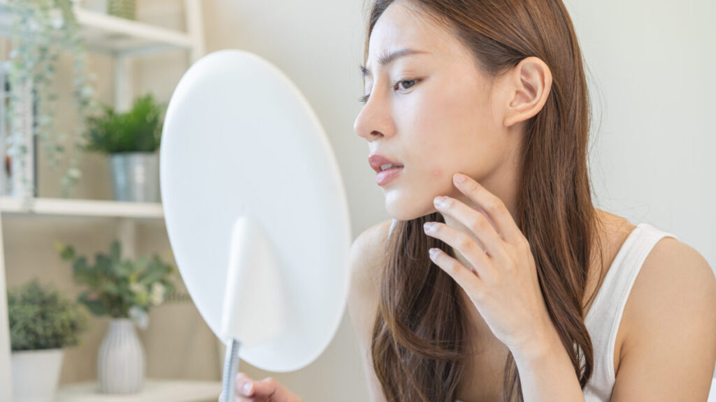 ニキビがあっても医療脱毛はできる！ニキビ肌への効果と注意点