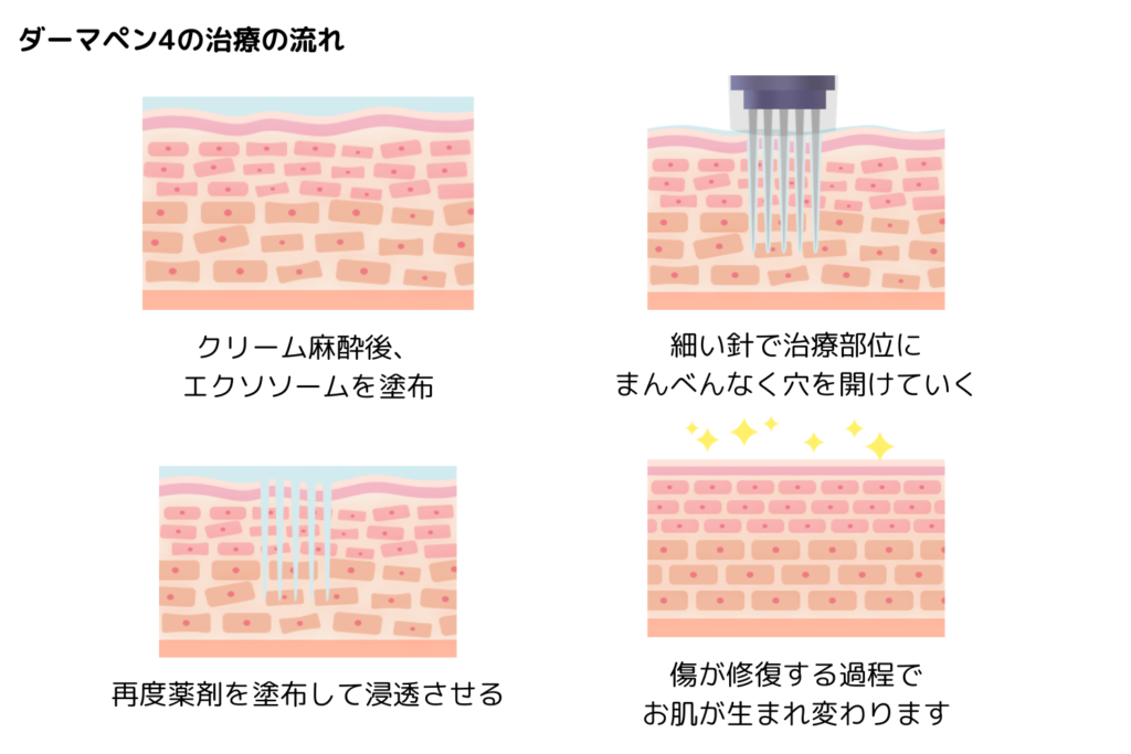 ダーマペン4とは