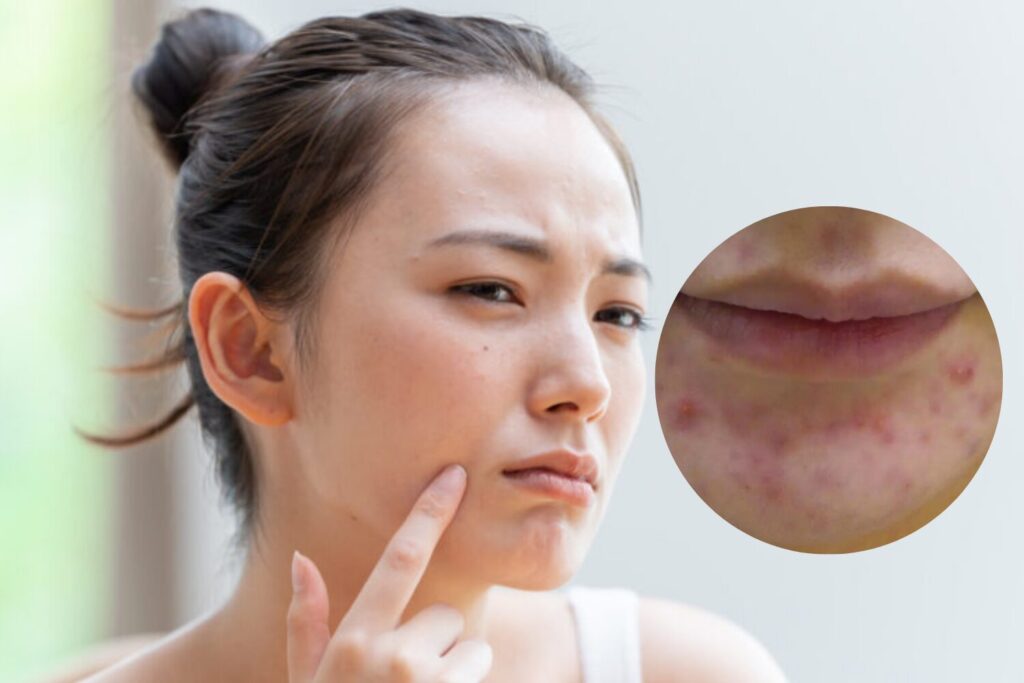 顎のニキビとしこりの原因と治し方って？効果的な予防法を公開！