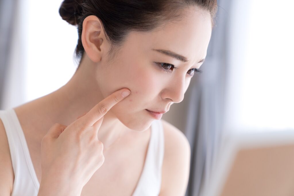 日焼け止めでニキビができると感じる理由