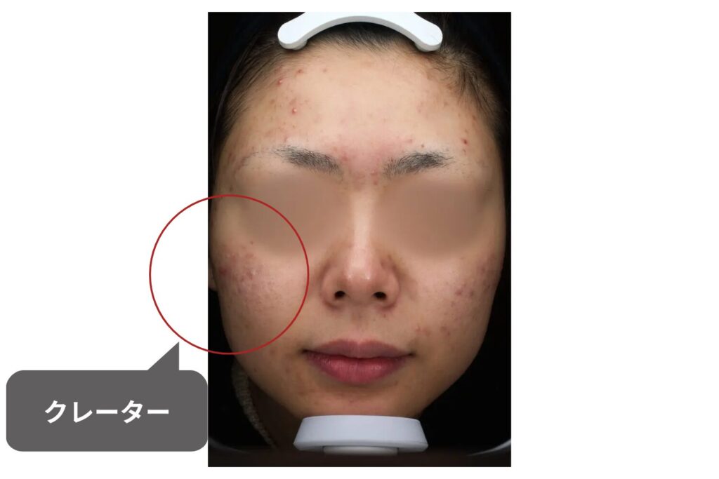 ニキビ跡のクレーターの原因は？種類と治療法を解説