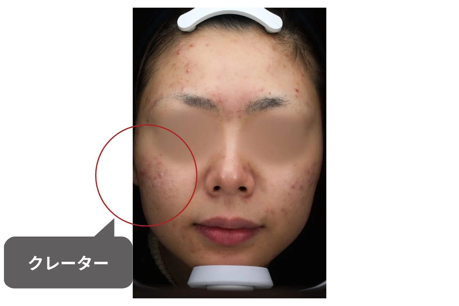 ニキビ跡のクレーターの原因は?種類と治療法を解説