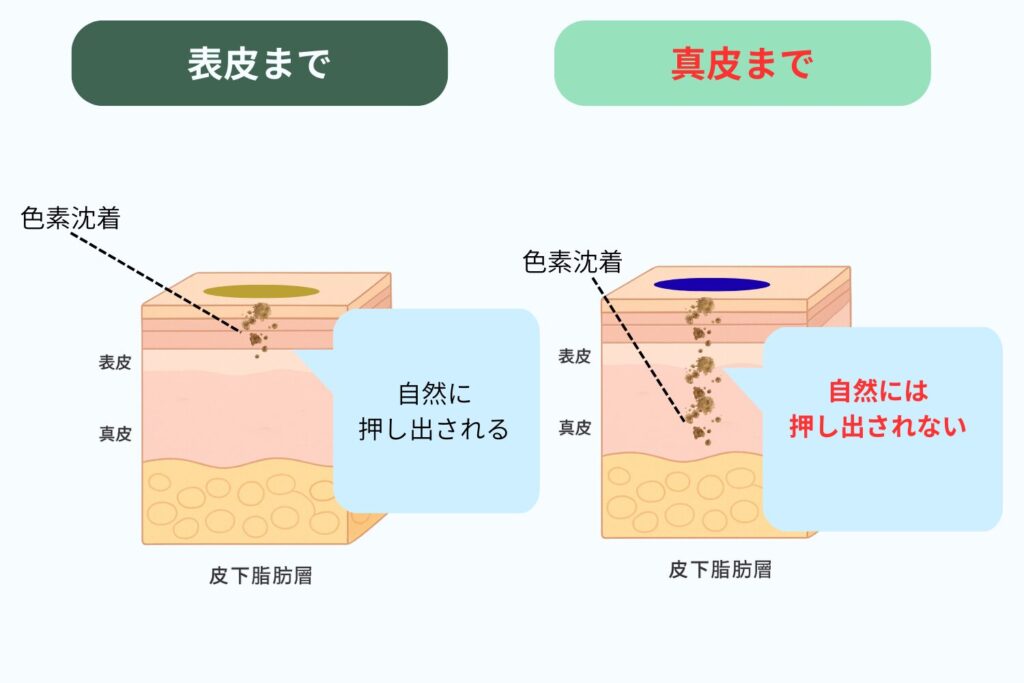 表皮と真皮の違い