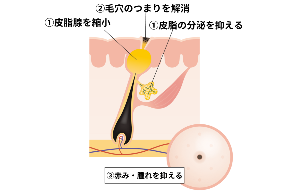 イソトレチノインはなぜニキビに効果があるのか？