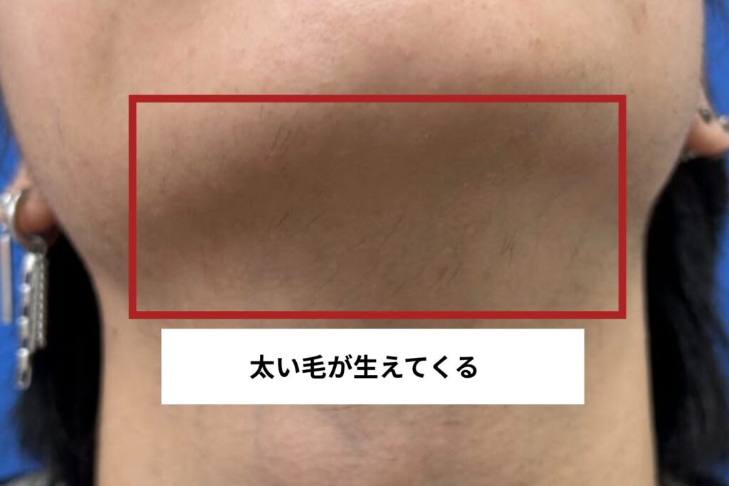 脱毛の硬毛化とは?