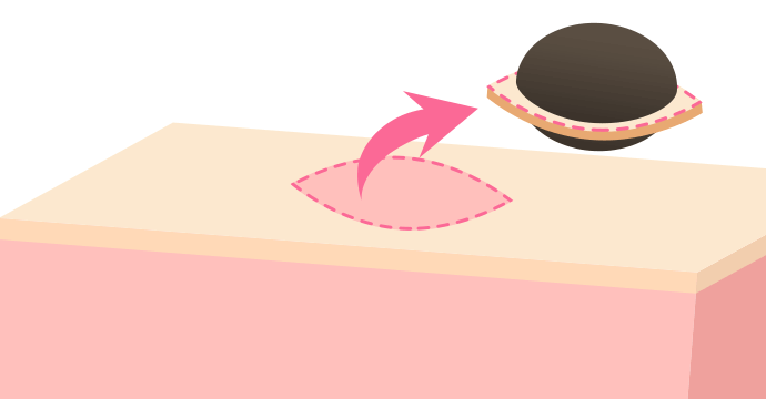 図解2 焼灼（しょうしゃく）除去術