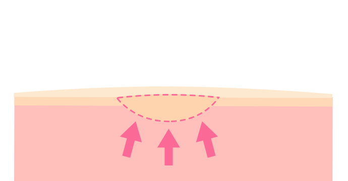 図解2 焼灼（しょうしゃく）除去術