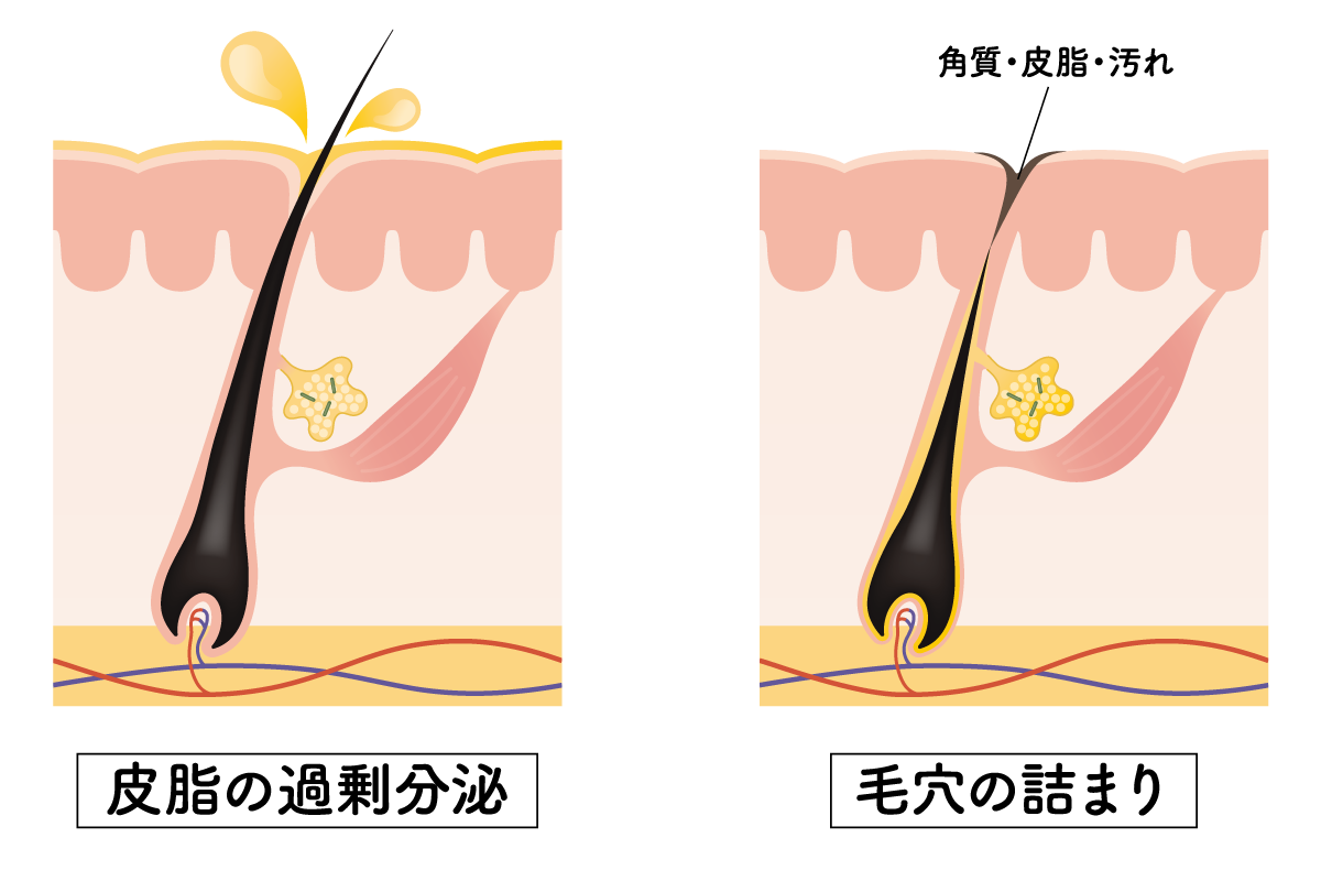 ニキビ図解①
