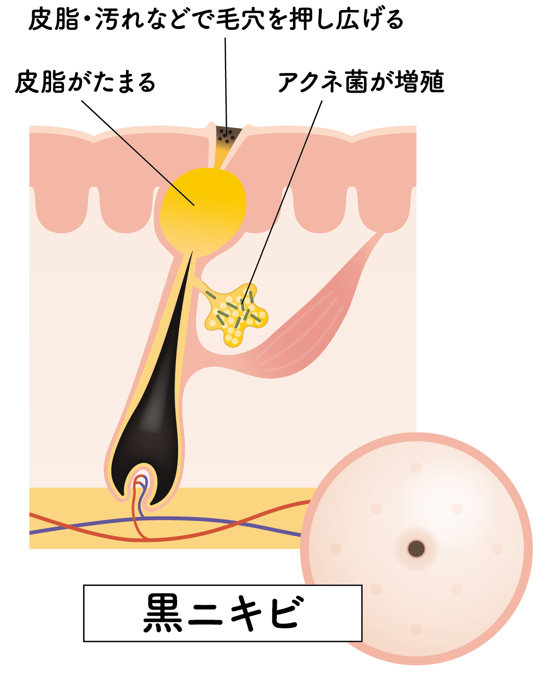 ニキビ図解③