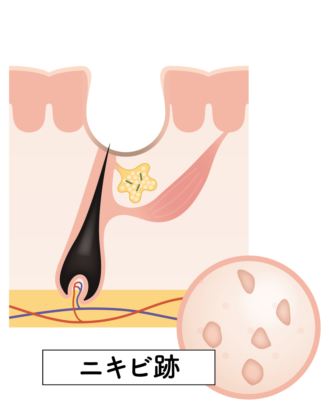 ニキビ図解⑥