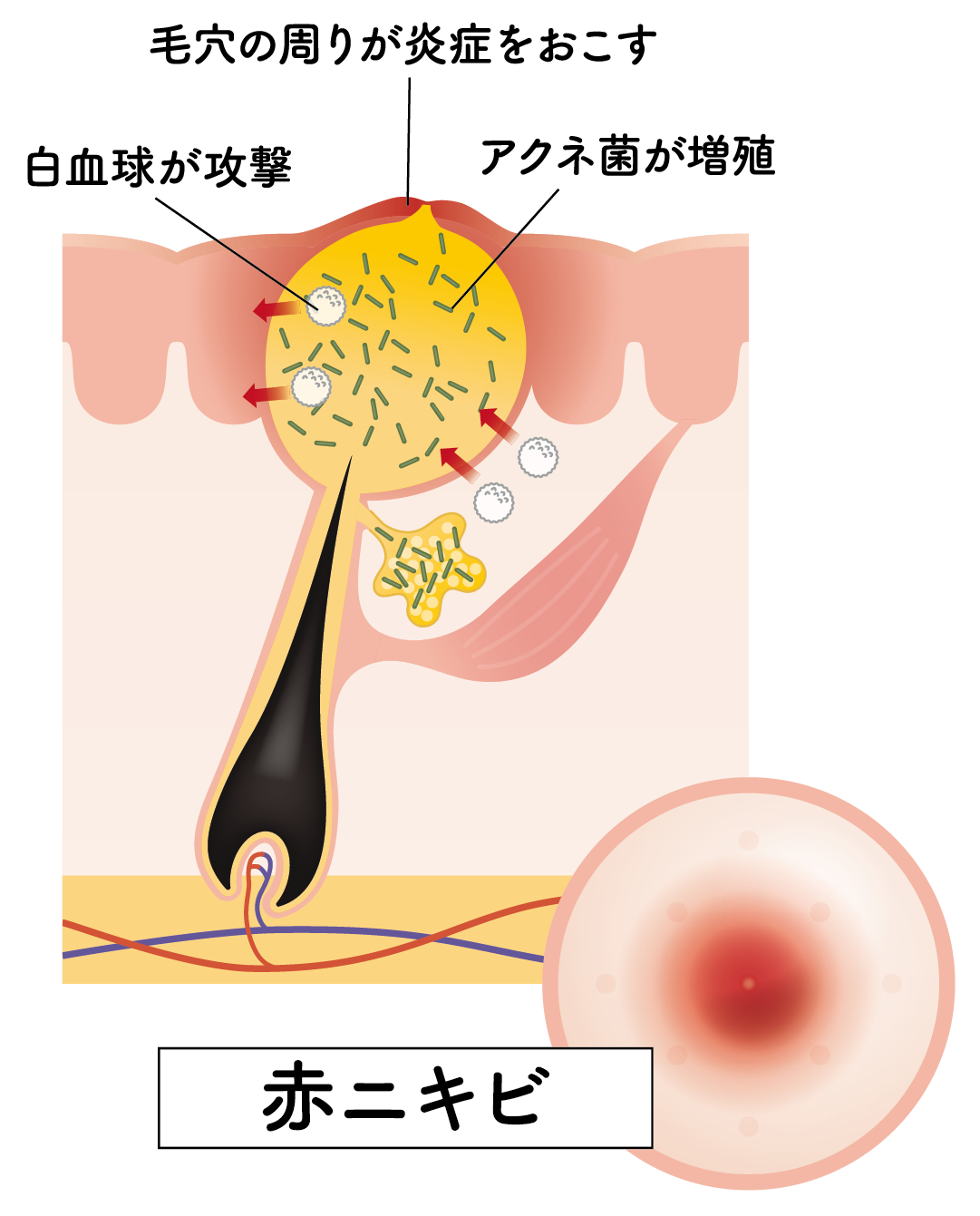 ニキビ図解④