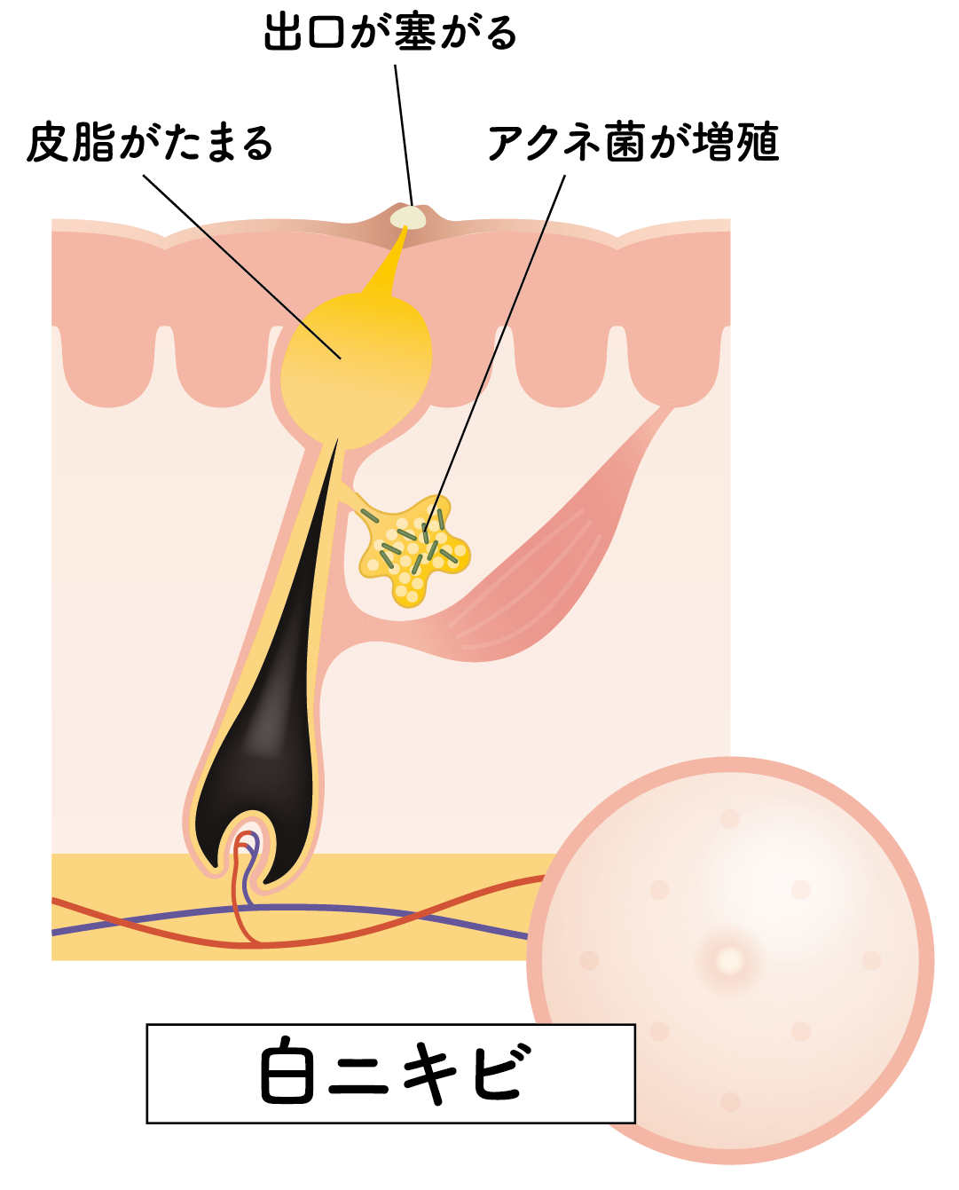 ニキビ図解②