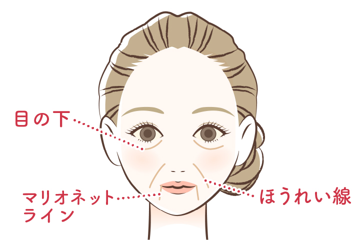 たるみしわの治療法図解