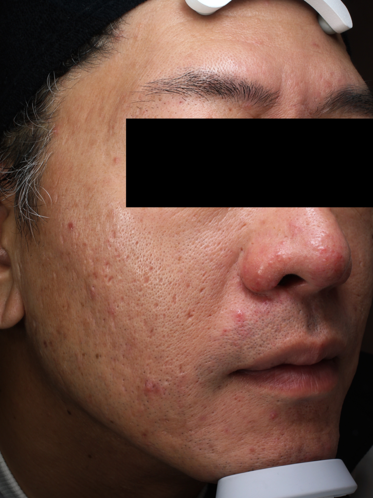 ニキビ症例男性①症例前