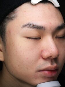 男性のニキビ症例②施術前