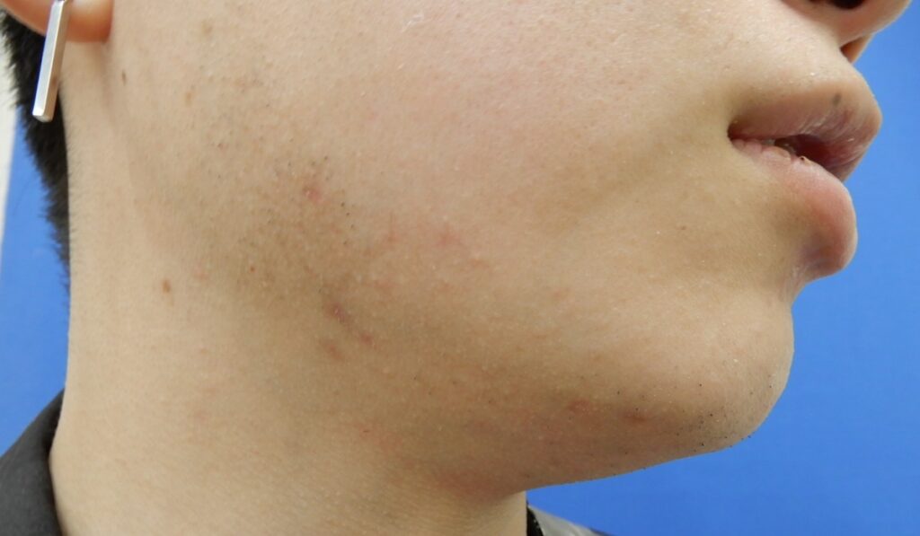 ヒゲ脱毛施術後